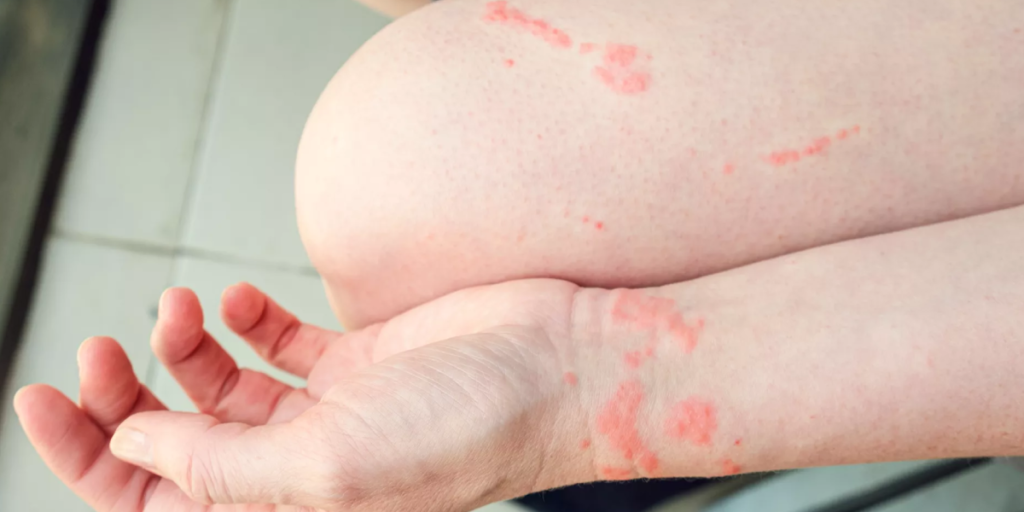 Cat Cancer Scratch What is Cat Scratch Disease?